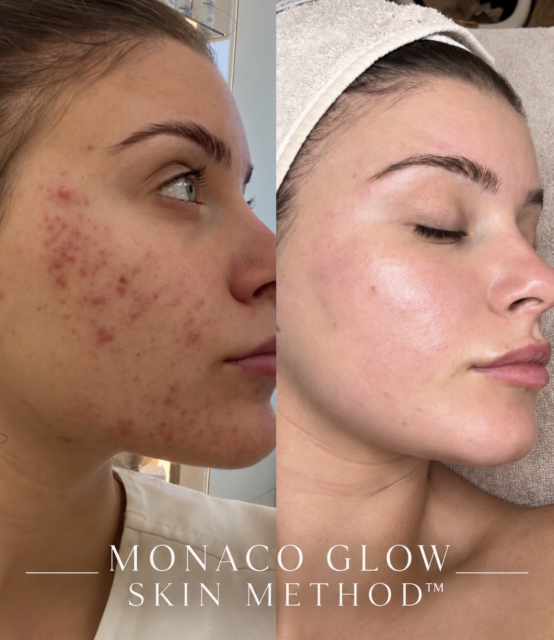 Koža lica pre i posle Monaco Glow Skin Method™ tretmana